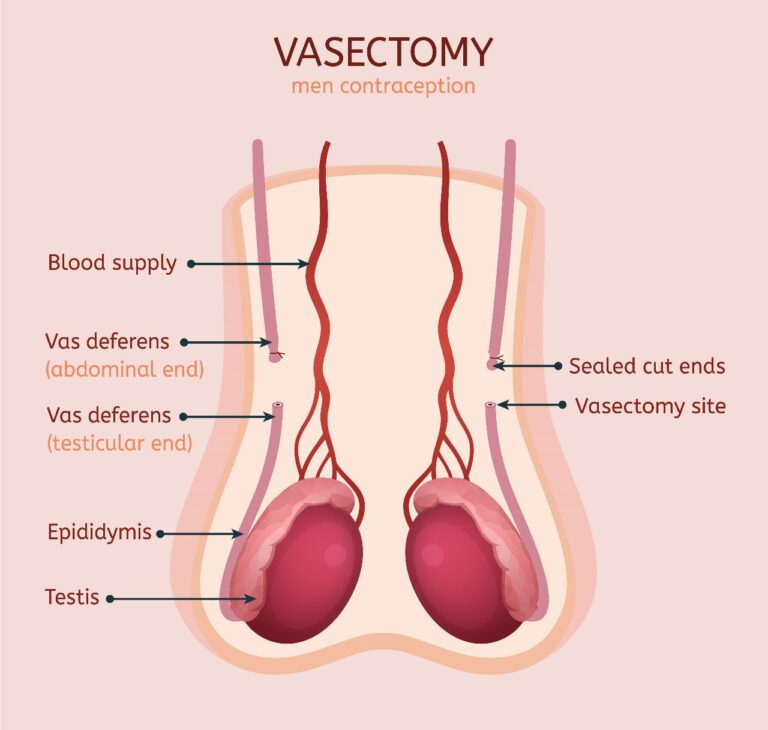 vasectomy specialist Melbourne